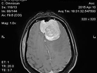 Гигантская менингиома передней трети фалькса (или возраст не болезнь)