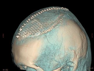 Большая гиперостотическая менингиома средней трети верхнего сагиттального синуса слева