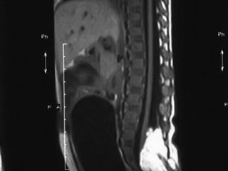 Spina bifida L4-S3. Липомиеломенингоцеле пояснично - крестцовой области. Синдром фиксированного спинного мозга