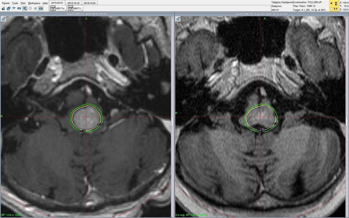 Обзор онкологических заболеваний метастазы рака и меланомы в головной мозг