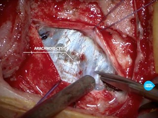 Фенестрация арахноидальной кисты у ребенка. Нейрохирург Землянский М.Ю.