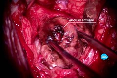 Удаление гемангиобластомы 4 желудочка. Нейрохирург Землянский М.Ю.