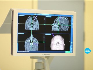 Имлантация резервуара Оммайя для аспирации кисты головного мозга. Нейрохирург Реутов А.А.